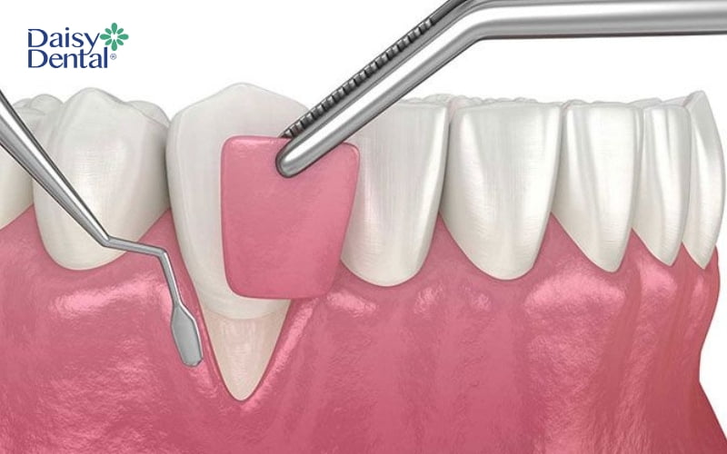 Ghép nướu để khắc phục tình trạng thiếu nướu sừng hóa
