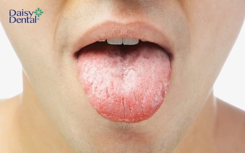 Tình trạng nứt đầu lưỡi rất phổ biến, đặc biệt là ở người lớn tuổi