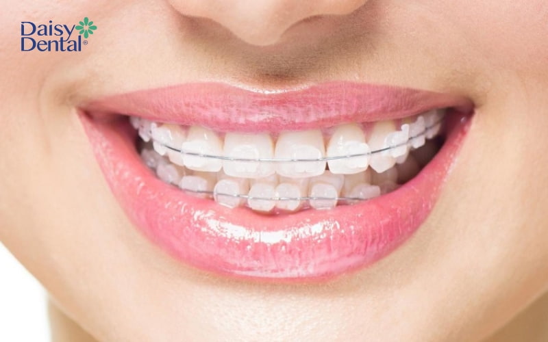 Niềng răng mắc cài sứ với chất liệu sứ có màu sắc tương đồng với màu răng thật, khó nhận biết