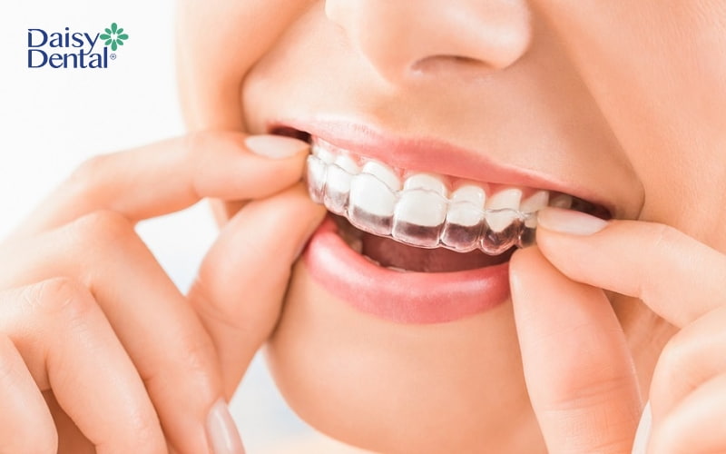 Niềng răng trong suốt dễ dàng tháo lắp và mang tính thẩm mỹ cao