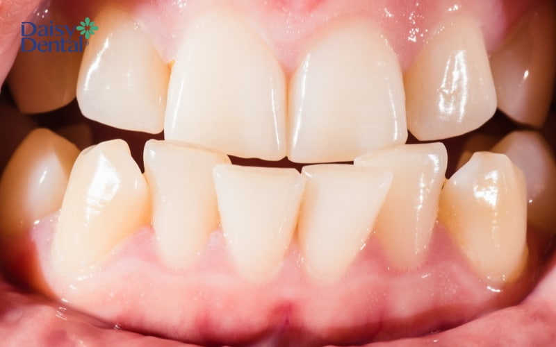 Răng mọc chen chúc là nguyên nhân dẫn đến tình trạng răng cửa chữ V