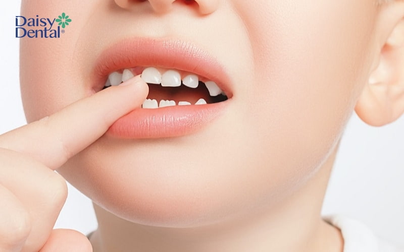 Thói quen xấu từ nhỏ như mút tay, tật đẩy lưỡi gây ra tình trạng răng chữ V