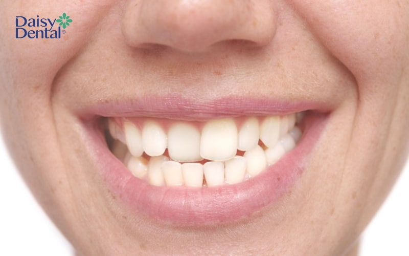 Răng cửa chữ V mọc lệch lạc gây ảnh hưởng đến tính thẩm mỹ khuôn mặt