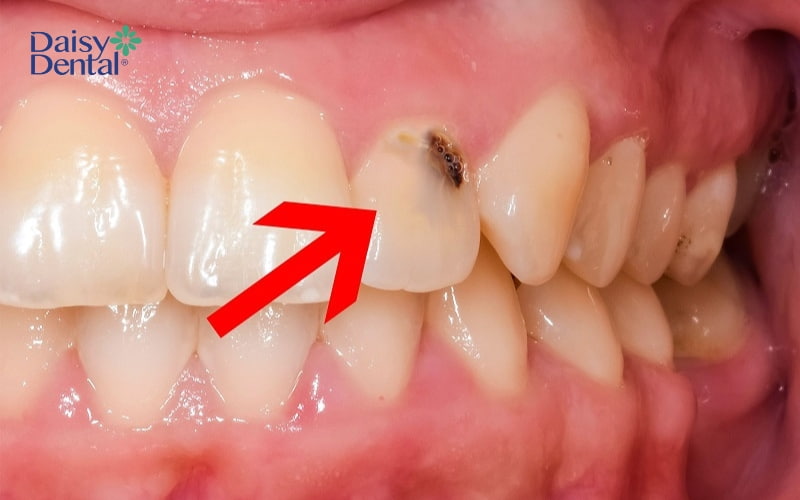 Răng cửa chữ V khiến việc vệ sinh răng miệng trở nên khó khăn, gây bệnh lý răng miệng