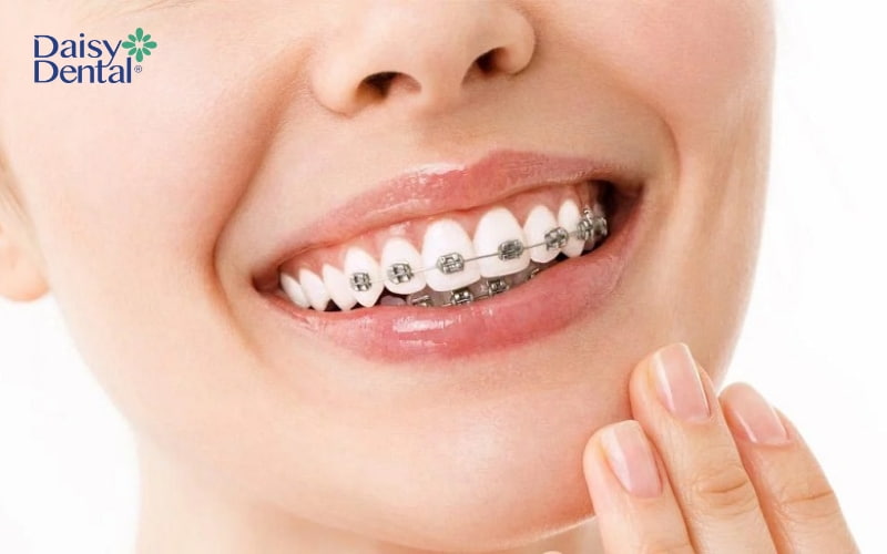 Niềng răng là phương pháp khắc phục răng chữ V được nhiều người lựa chọn