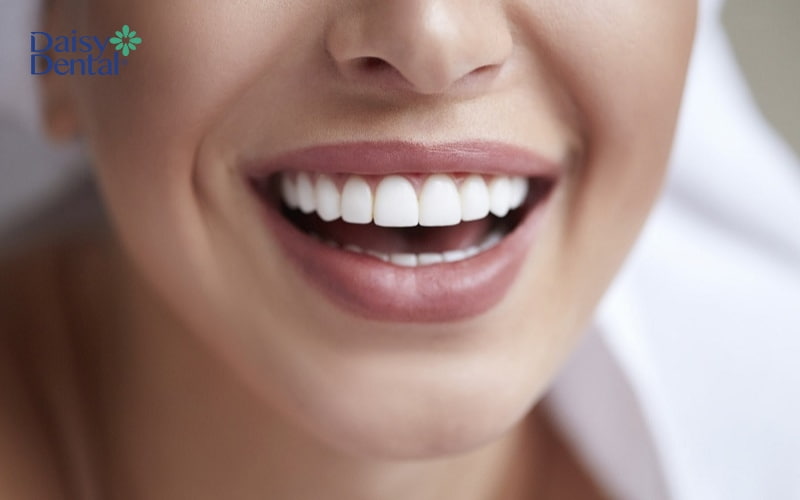 Bọc răng sứ giúp mang đến hàm răng đều, đẹp