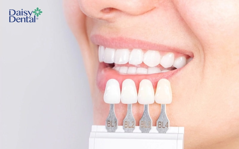 Bác sĩ sử dụng mặt dán sứ mỏng gắn lên bề mặt răng