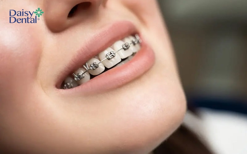 Niềng răng mắc cài kim loại truyền thống có chi phí thấp