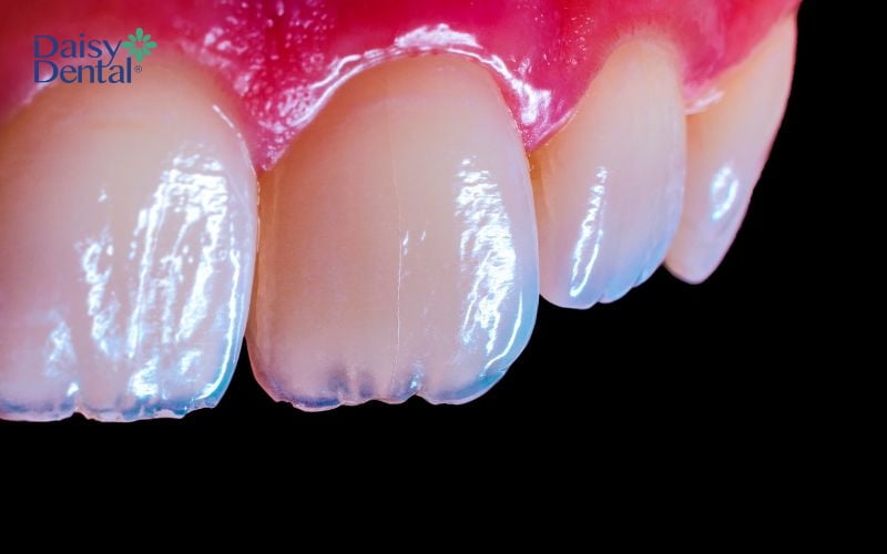 Cần phân biệt răng vàng tự nhiên hay vàng do mảng bám, cao răng