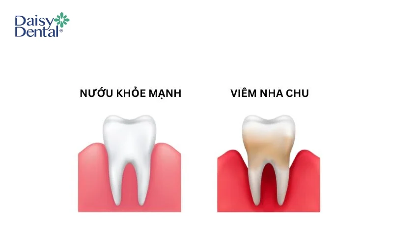 Viêm nha chu là bệnh lý dẫn đến lung lay, mất răng