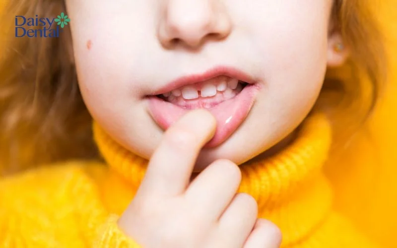 Cần cẩn thận khi cho trẻ em sử dụng thuốc bôi chữa viêm nha chu