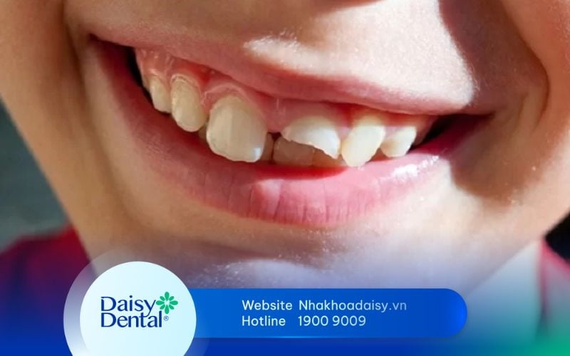 Bị gãy răng thương tích bao nhiêu phần trăm? Lưu ý cần biết