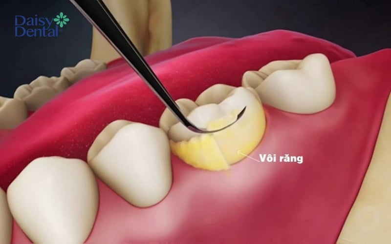 Vôi răng tích tụ là một trong những nguyên nhân phổ biến gây vết đen trên răng