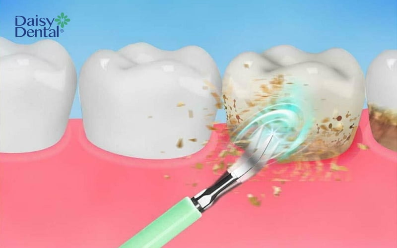 Vôi răng được loại bỏ hoàn toàn bằng dụng cụ chuyên dụng