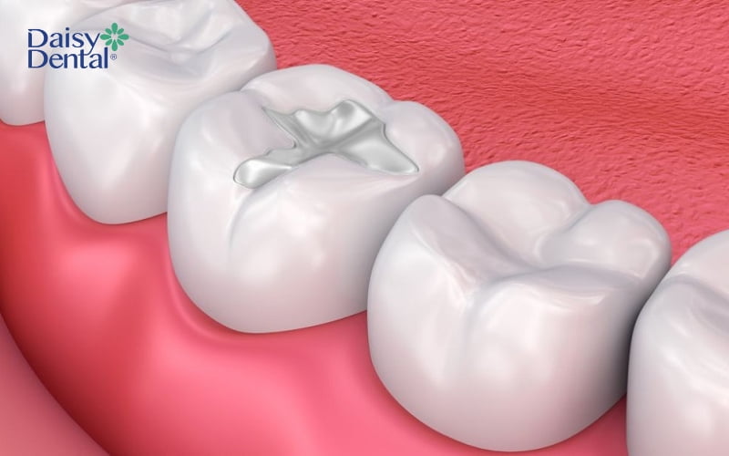 Trám răng được bác sĩ chỉ định trong trường hợp sâu răng nhẹ