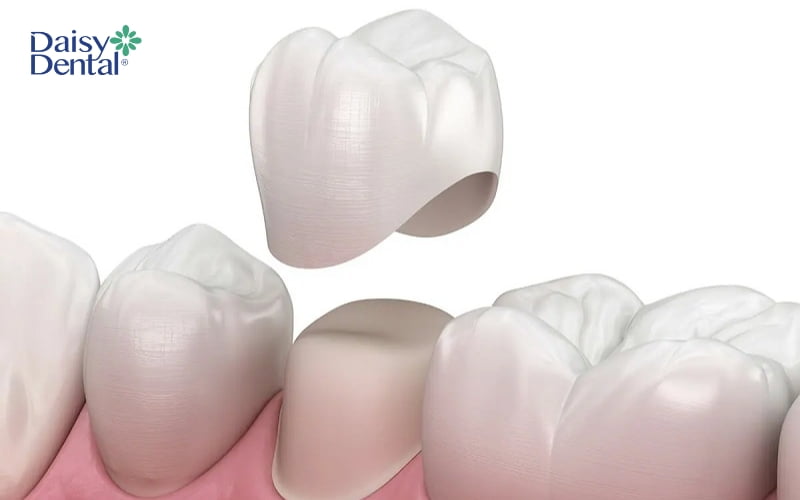 Nếu sâu răng nặng, bác sĩ sẽ chỉ định bọc răng sứ để khắc phục