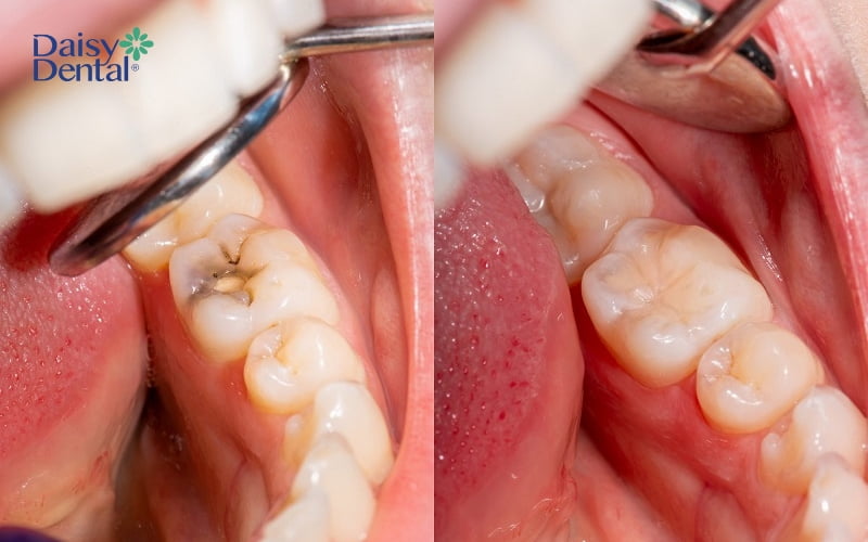 Hàn trám răng được chỉ định để điều trị sâu răng ở mức độ nhẹ