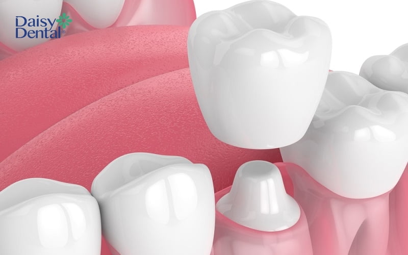 Bọc răng sứ giúp khôi phục chức năng của răng sau khi điều trị tuỷ