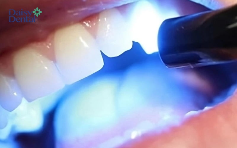 Bác sĩ sẽ chiếu đèn laser để làm đông cứng vết trám