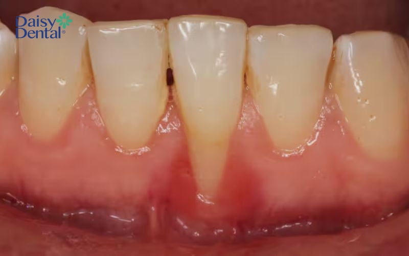 Xỉa răng sai cách là nguyên nhân hàng đầu làm tổn thương lợi