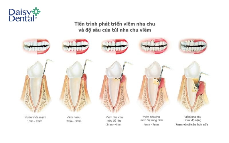 Xỉa răng bằng tăm có thể dẫn đến viêm nha chu và mất răng