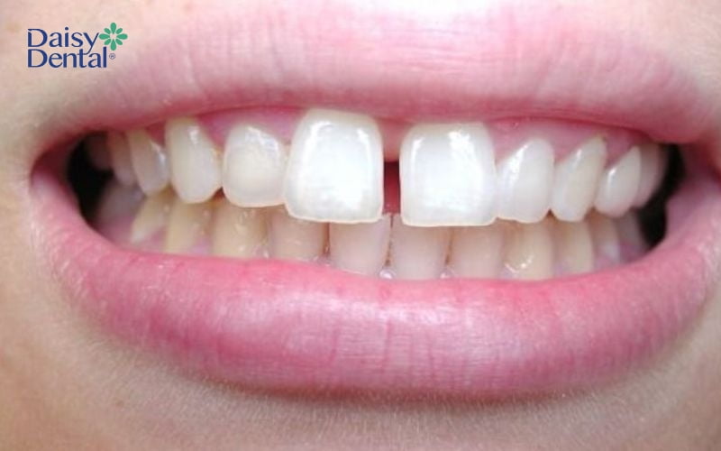 Xỉa răng bằng tăm sẽ dẫn đến thưa răng