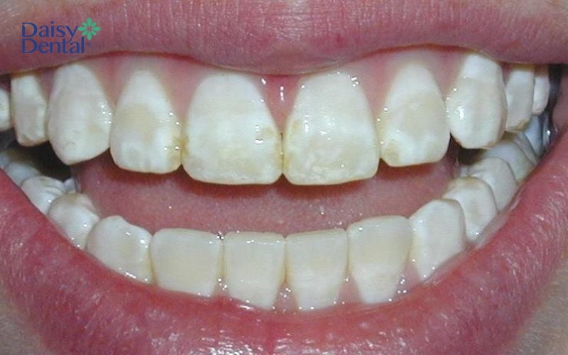 Đầu tăm nhọn dễ làm hỏng men răng khi xỉa răng quá thường xuyên