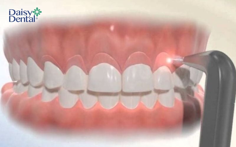 Mài xương ổ răng là giải pháp giúp giảm độ dày của vùng xương ổ
