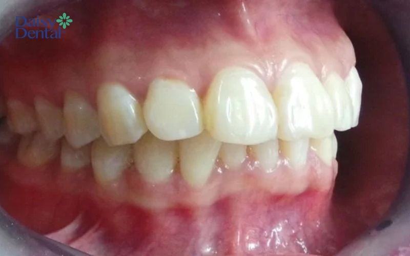 Mài xương ổ răng là phương pháp điều trị hô do hàm hiệu quả