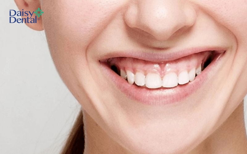 Bên cạnh điều trị hô vẩu, mài xương ổ răng cũng giúp khắc phục tình trạng cười hở lợi hiệu quả