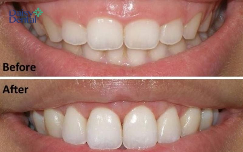 Mài xương ổ răng được chứng minh mang lại tác dụng chữa hô hiệu quả