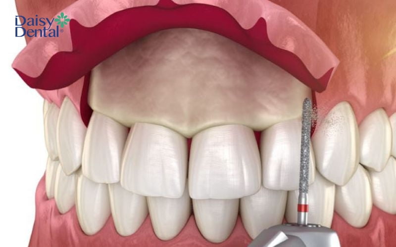 Mài xương ổ răng sẽ gây ra cảm giác đau sau khi tan thuốc tê, tuy nhiên có thể kiểm soát được