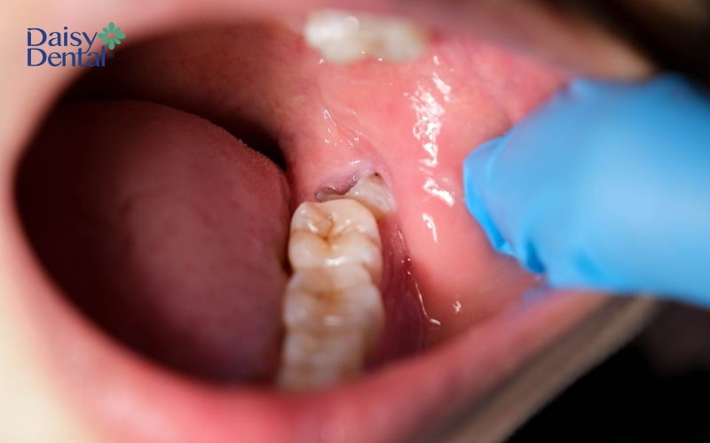 Tổn thương thần kinh cũng thường dẫn đến việc nhổ răng khôn 1 tuần vẫn đau