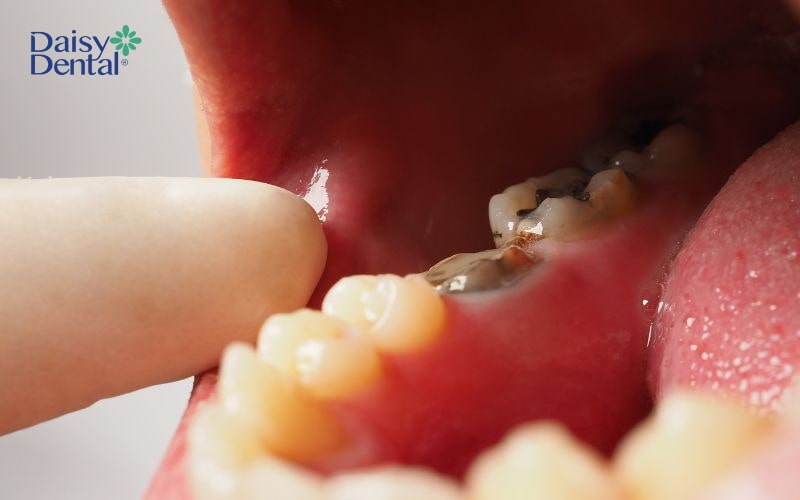 Răng lân cận bị sâu tạo điều kiện cho vi khuẩn tích tụ