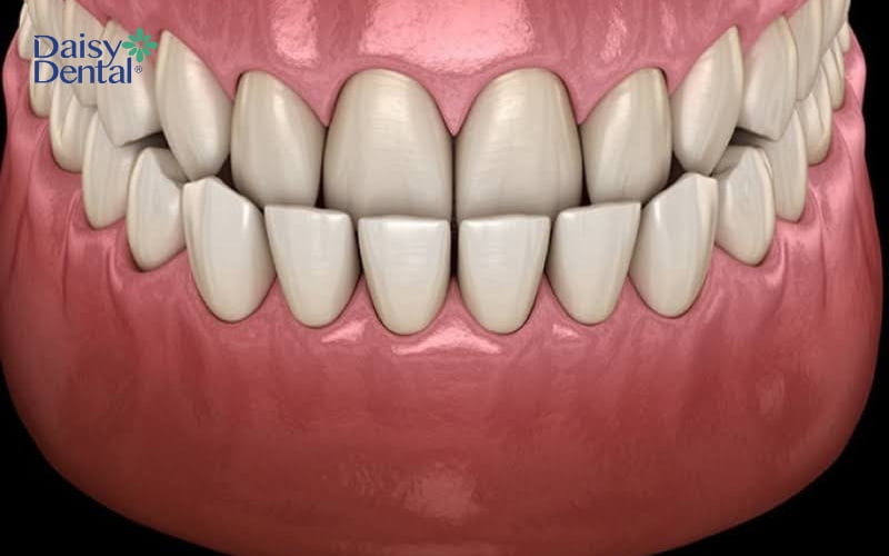 Tình trạng răng hàm dưới chìa ra so với hàm trên