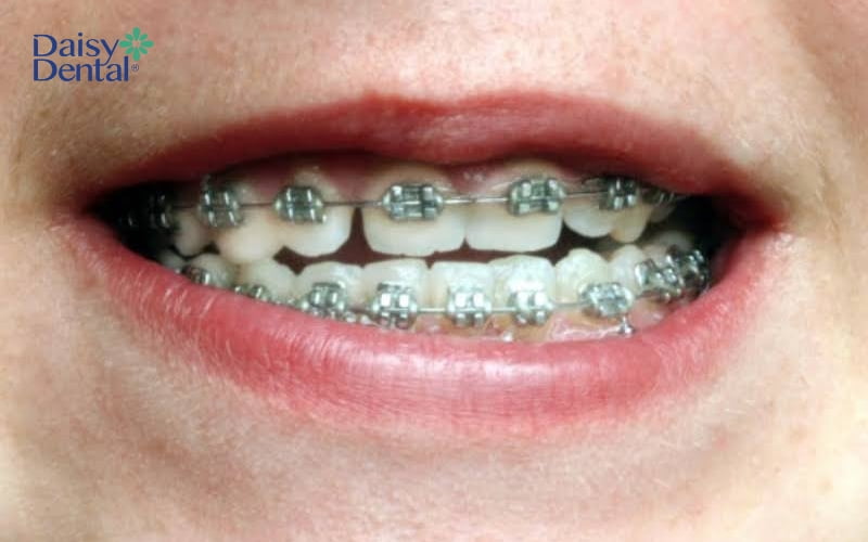 Niềng răng mắc cài kim loại khắc phục tình trạng khớp cắn ngược nhẹ