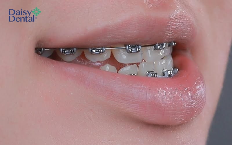 Tùy tình trạng và mức độ phức tạp của răng mà thời gian chỉnh nha sẽ kéo dài hơn
