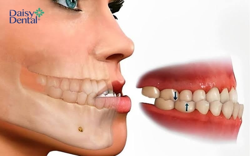 Trong trường hợp tình trạng khớp cắn ngược là do hô hàm, bác sĩ sẽ tư vấn phẫu thuật chỉnh xương