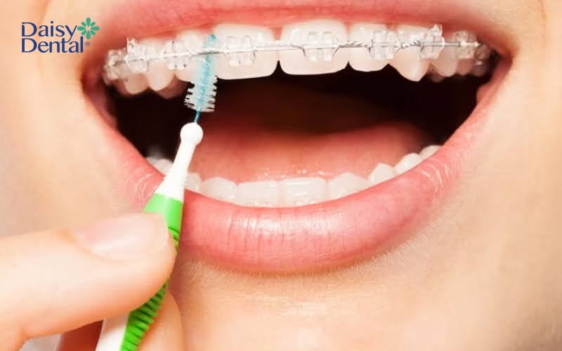 Trong thời gian niềng răng, bạn nên dùng bàn chải kẽ để loại bỏ mảng bám ở mắc cài