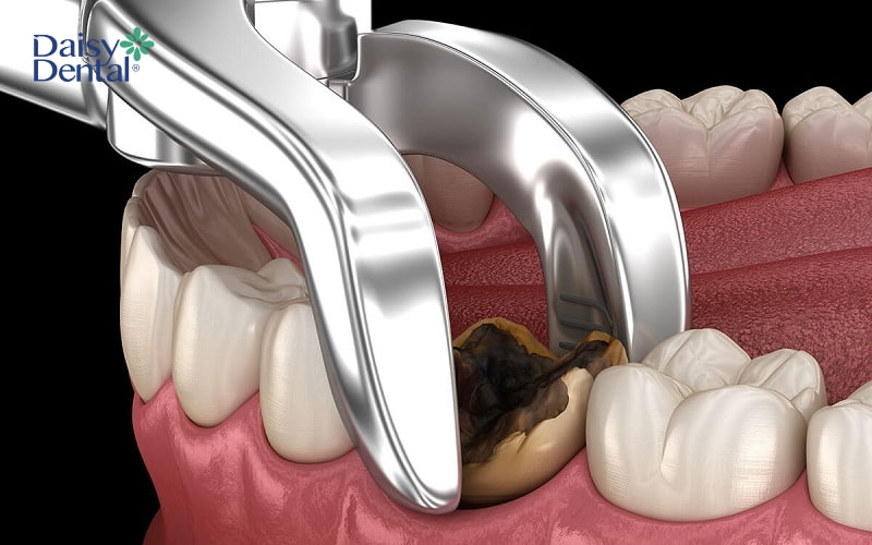 Răng số 5 bị sâu nặng, không thể điều trị là một trong số các trường hợp được bác sĩ chỉ định nhổ