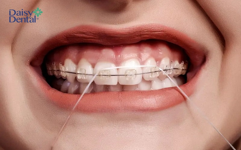 Sau khi nhổ răng, bạn cần chăm sóc răng miệng đúng cách