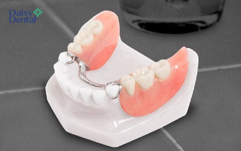 Răng giá tháo lắp bán phần nhựa cứng thường khá dày và thô