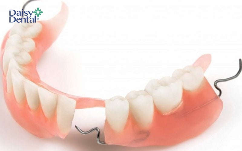 Răng giá tháo lắp bán phần kim loại dễ gây kích ứng cho người dùng