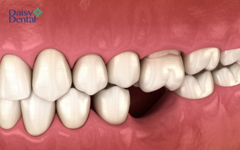 Mất một răng hay mất nhiều răng cũng có thể sử dụng răng giả tháo lắp bán phần