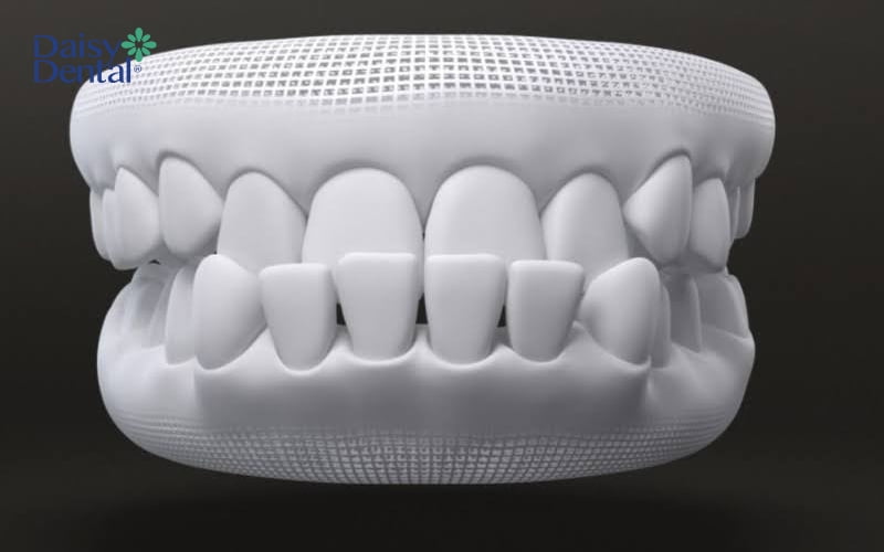 Răng cửa hàm dưới có xu hướng đưa ra ngoài và che phủ răng hàm trên