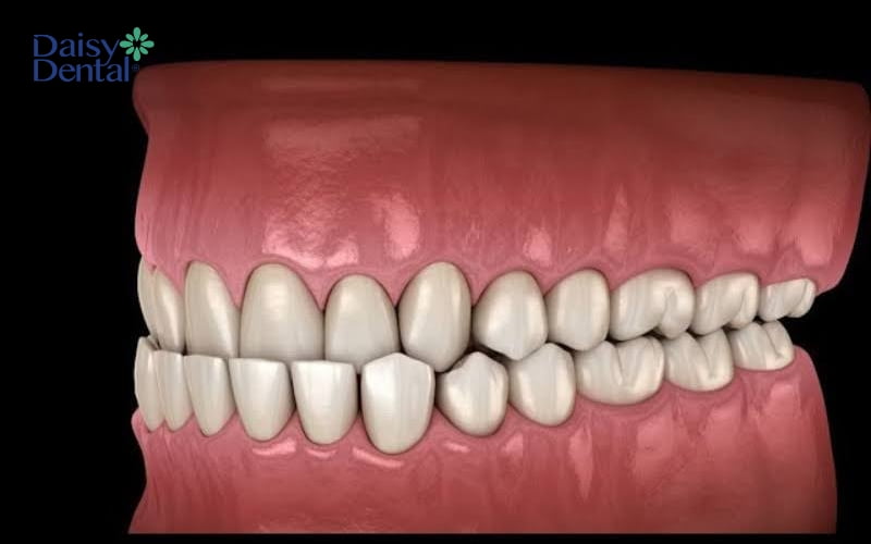 Tình trạng móm so răng mọc sai lệch