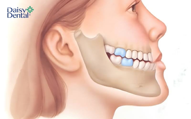 Xương hàm dưới mọc phát triển quá mức so với xương hàm trên