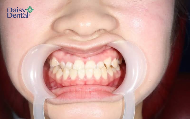 Trình trạng móm do cả răng và xương hàm