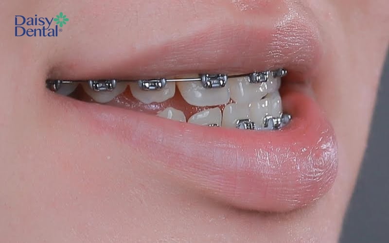 Niềng răng là một trong những phương pháp tối ưu nhất để khắc phục tình trạng răng móm