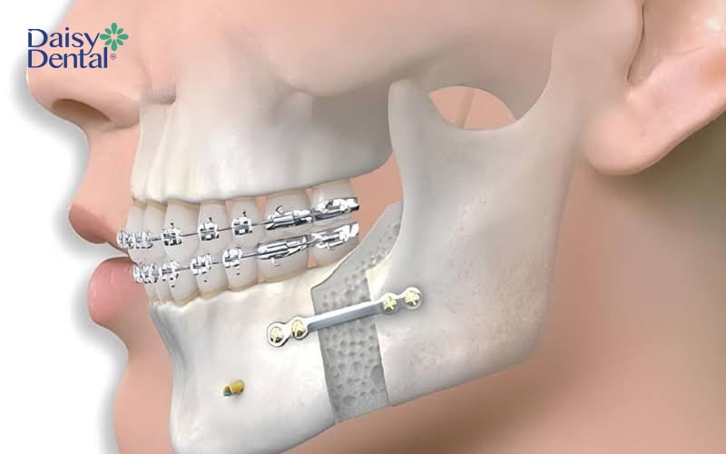 Trong trường hợp hô do xương hàm, bác sĩ có thể tư vấn phẫu thuật hàm kết hợp với niềng răng